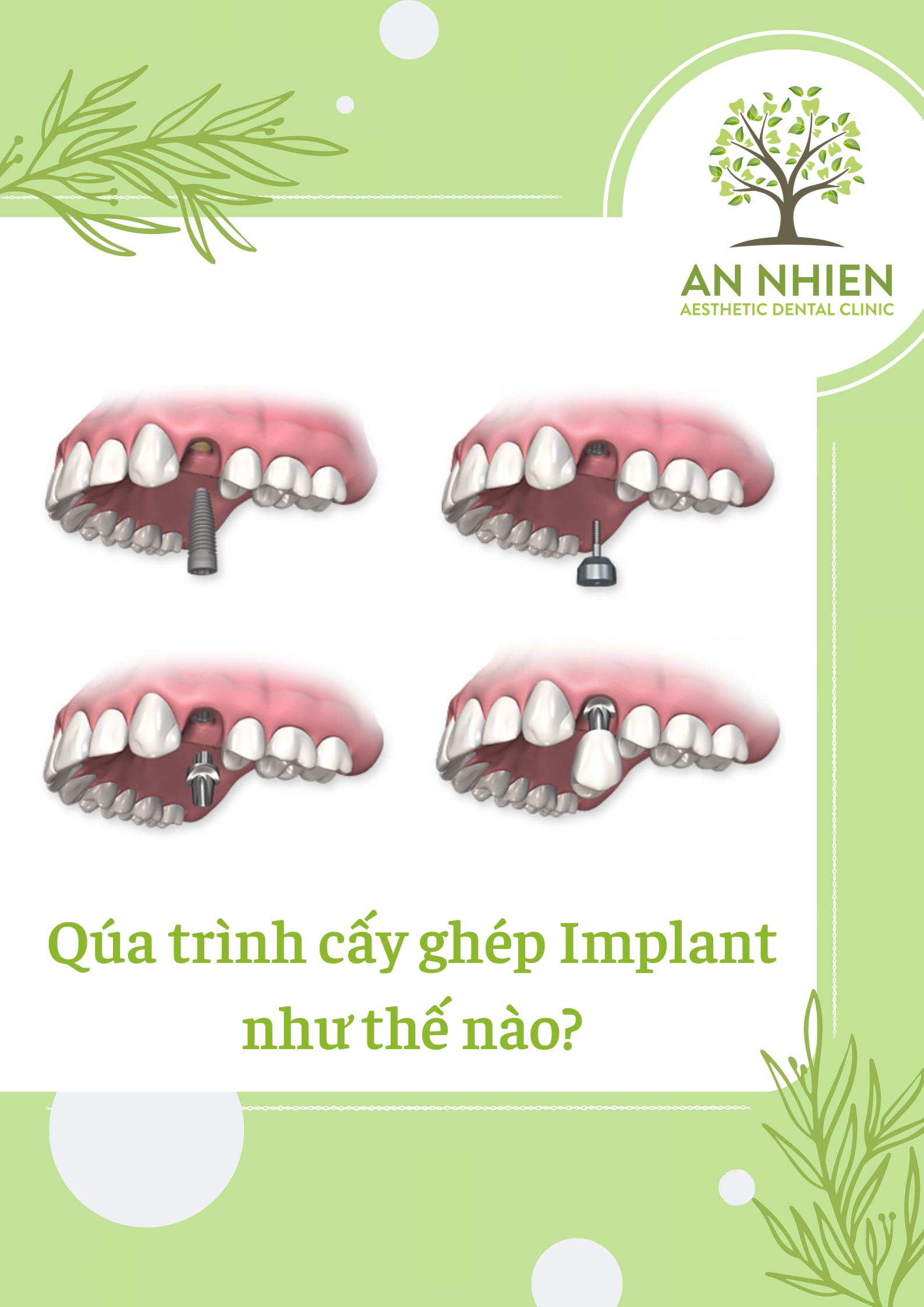 Cấy ghép Implant phù hợp với ai? Quy trình cấy ghép Implant diễn ra như thế nào ?